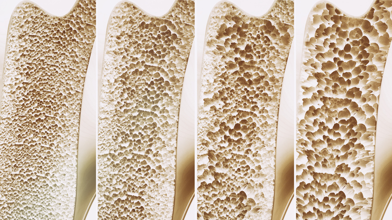 Knochen gesunder knochen vier Stadien bis Osteoporose